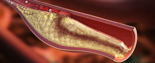 METABOLISMO LIPROPROTEICO