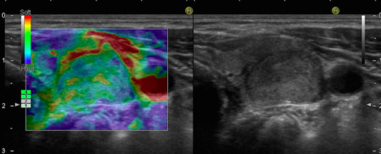 ELASTOSONOGRAFIA TIROIDEA