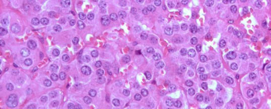 FEOCROMOCITOMA PARAGANGLIOMA