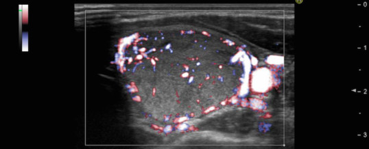 AFIRMA GSC X ATLAS: MOLECULAR ANALYSIS IN FOLLICULAR THYROID NODULES (THY3, BETHESDA III o IV)