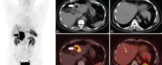 GASTRINOMA (SINDROME ZOLLINGER-ELLISON)