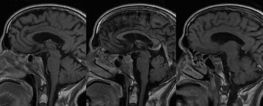 CARCINOMA IPOFISARIO