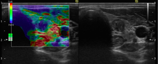 MICROCARCINOMA PAPILLARE DELLA TIROIDE: SORVEGLIANZA ATTIVA